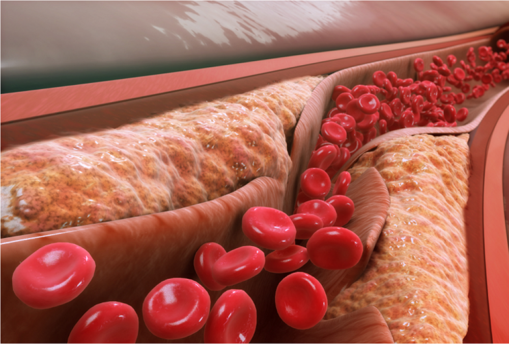علائم و نشانه های چربی خون بالا چیست؟