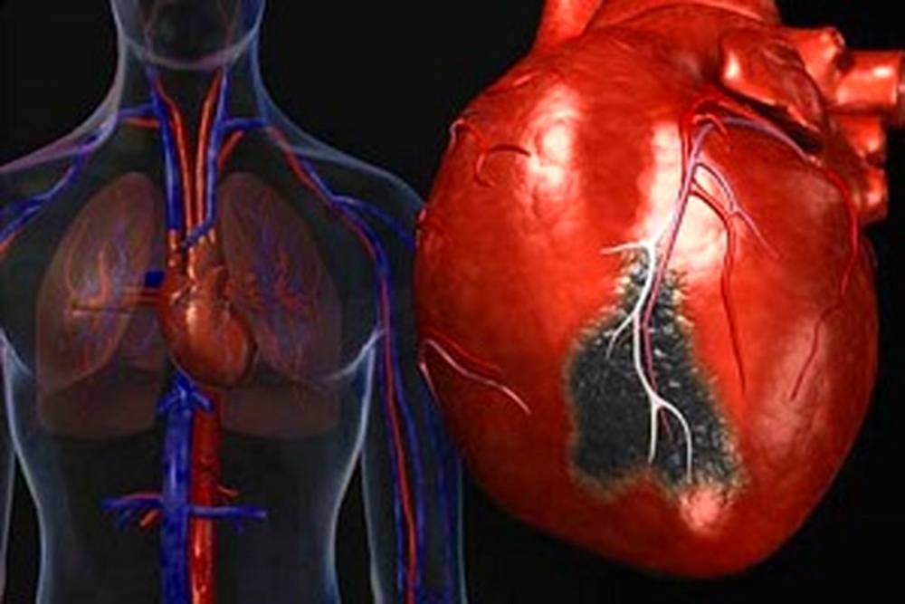 عفونت‌های قلبی و عوامل ایجاد عفونت در قلب