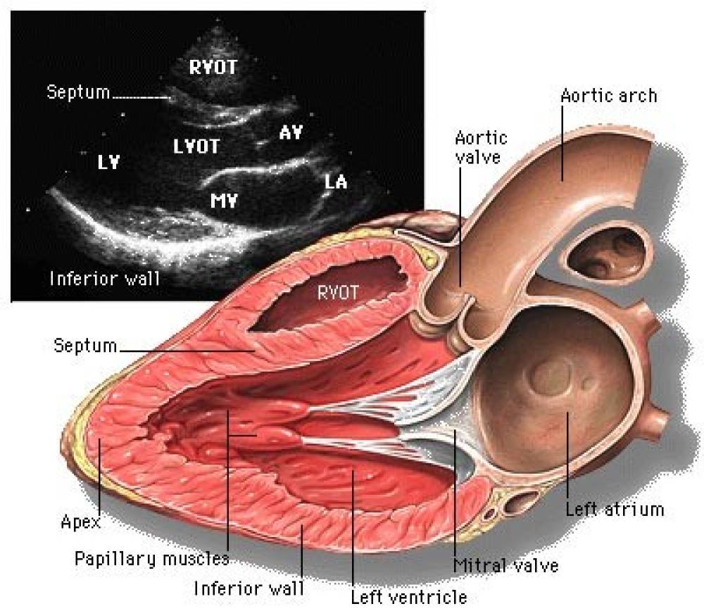 تشخیص سوراخ قلب با اکو داپلر توسط دکتر سوده رودباری متخصص بیماری های قلب و عروق
